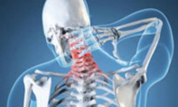 اسپوندیلوز گردن اسپوندیلوز گردن